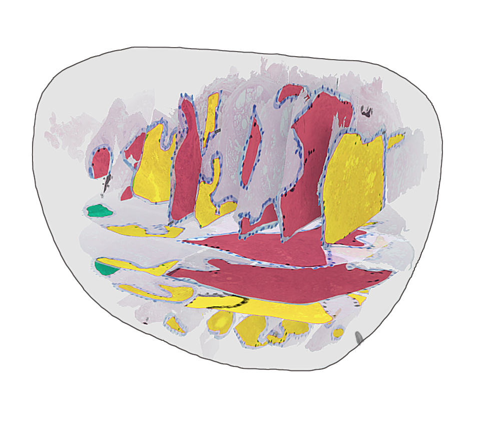 Histological sections from a prostate sample, showing different gleason grades throughout the tumor